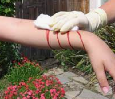 Control of bleeding injuries